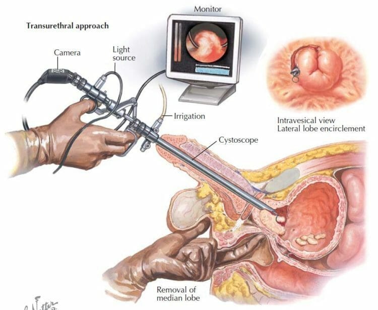 Transurethral Resection of The Prostate (TURP) : Operasi Pembesaran Prostat Secara Endoskopi