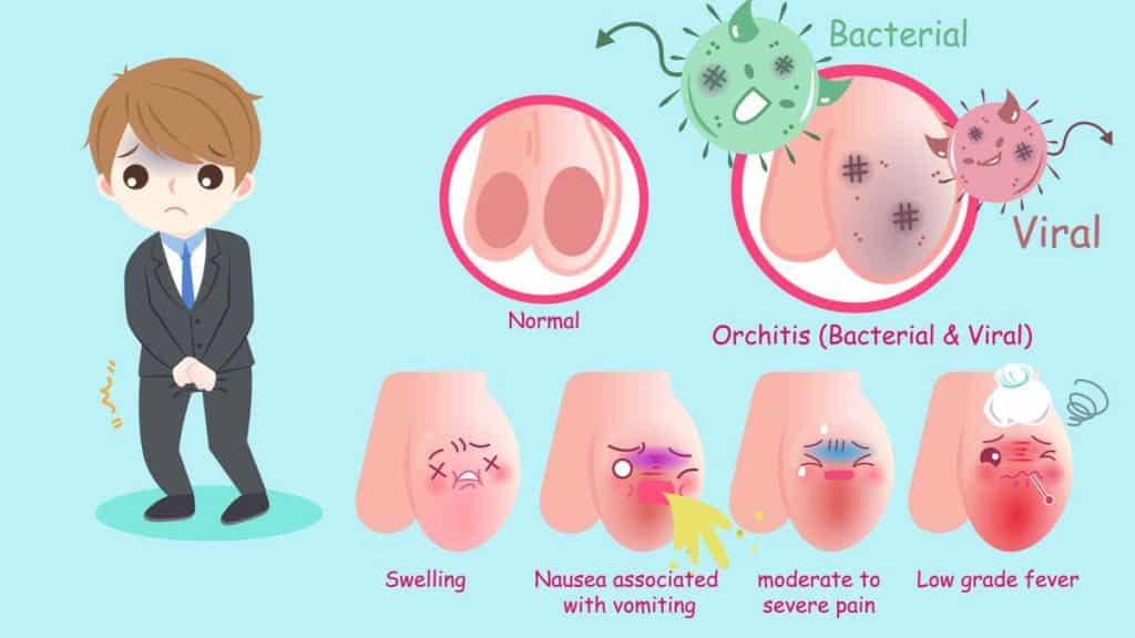 orchitis penyebab nyeri testis Orchitis adalah radang di testis dan merupakan salah satu penyebab radang testis