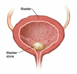 coronal section of bladder showing bladder stone. source: original art. used in 9a12236, 82987, versions in 4c940397, 5b940397, 4a940397, 90920.