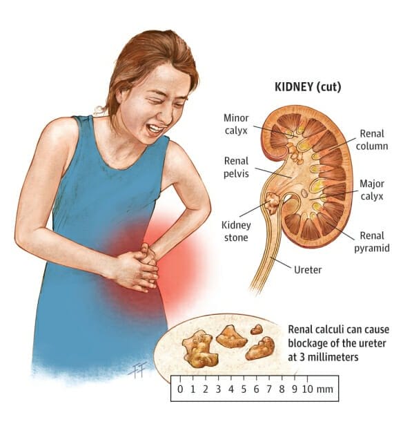 3 Tips Cara Mengatasi Batu Ginjal Saat Kumat Sebelum Ke Rumah Sakit   Cara Mengatasi Batu Ginjal Saat Sedang Sakit 